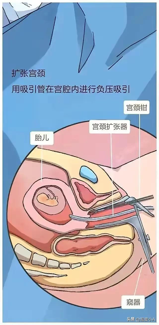 人流手术的时间选择与注意事项——关于几个月能做人流的探讨